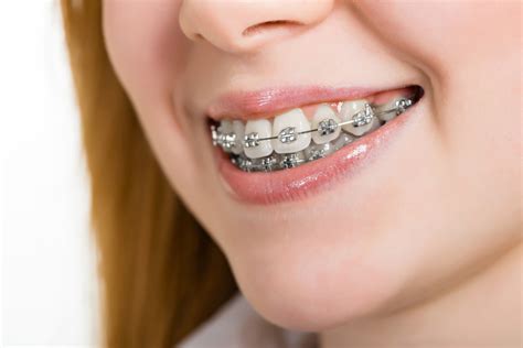 tipos de brackets metalicos autoligables|como se colocan los brackets.